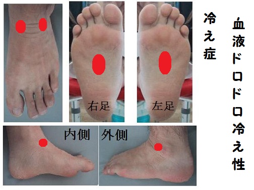 血液ドロドロ冷え性