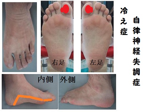 冷え症（自律神経失調症の場合）