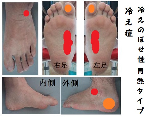 冷えのぼせ性 胃熱タイプ