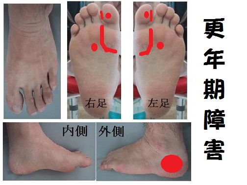 更年期障害に有効な反射区（足ツボ）