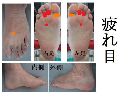 疲れ目の反射区（足つぼ）