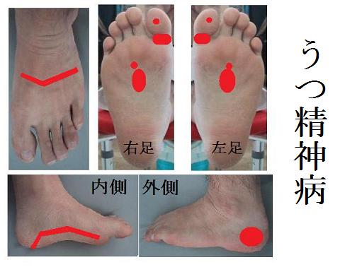 うつ精神疾患に効く反射区